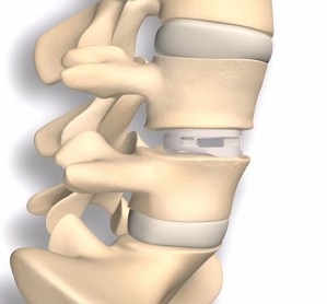 Titan implant bone f1E2038