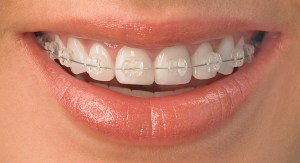 brackets