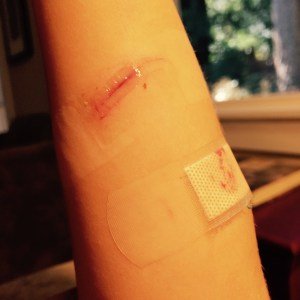 Dermabond