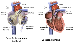 Syncardia TAH Esp